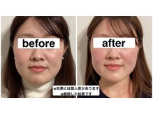 グリーン鍼灸整体院(green鍼灸整体院)/美容鍼（ビフォーアフター）