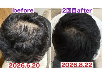 サロンノコ(salon NOKO)の写真/≪メンズ育毛促進におすすめ≫抜け毛/細毛/前髪の後退など髪のお悩みに◎ボリューム&ハリコシのある髪に！