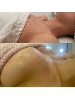 メゾン アンジュ(Maison Ange)/【B→F バストアップ症例】