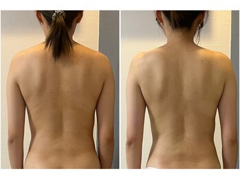 モア(moa)/猫背/肋骨/腰回り/首凝り