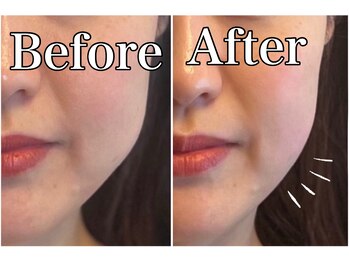 モッチ 天神大名店(MOCCHI)/エラ張さん必見