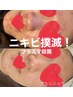 ［ニキビ撲滅］プラズマ殺菌！価格破壊★最安値・学割プラソニック　¥4,400