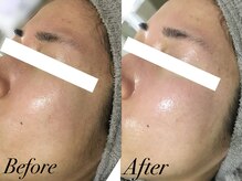 リララ 江坂店(Lelala)/磁気パック★ビフォーアフター！