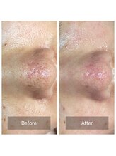 ヒール(heal)/いちご鼻撃退！！