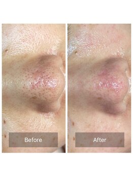 ヒール(heal)/いちご鼻撃退!!