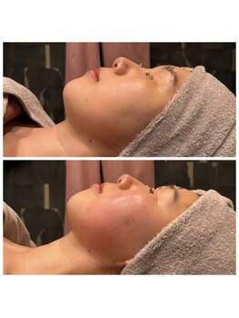 ビュウナ 銀座(BEAUNA)/カルテットモード全顔