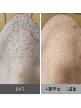 キムラケ 和光別邸(木村家 KIMURAKE)/メンズ脱毛ヒゲビフォーアフター