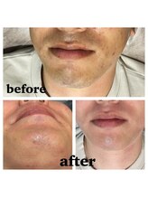 ゆいまーるはうす/ヒゲ脱毛メンズ脱毛