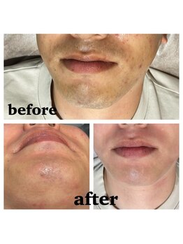 ゆいまーるはうす/ヒゲ脱毛メンズ脱毛