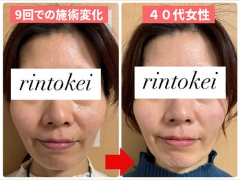 凛と慶/長居-美容鍼-経過