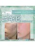 Q会員様専用ニキビケアしたい方はコレ！！【究極美肌セット】