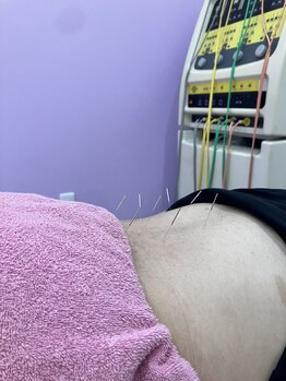 カルミア鍼灸接骨院/鍼施術例(腰)