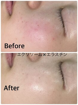 ルミネル 名古屋新栄(Luminelle)/エクソソーム