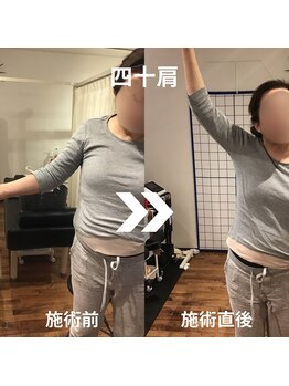 からだサロン サニー 堺東(SUNNY)/肩の痛み