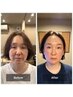 【一目瞭然の小顔実感！】ルート鬼美容鍼45分！￥15000