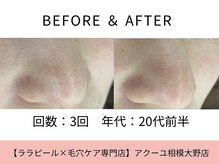 ア クーユ 相模大野店/毛穴洗浄/毛穴の黒ずみ/美肌