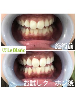 ルブラン 奈良店(Le Blanc)/いい印象受ける白い歯！