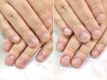 リファーレ(RIFARE)/【深爪矯正】当日の仕上がり◎