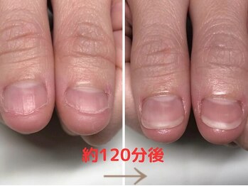 クウ(KUU)/即日見た目改善深爪ネイル