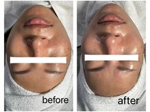 ベルエス(bell.s)/最強◆小顔ケア