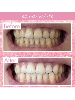 エクシアホワイトニング 高松本店/ホワイトニングビフォーアフター