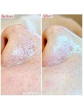 ウェルビーイング(well-being)/毛穴洗浄ビフォーアフター