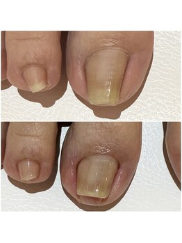 チョチョワンプラス(緒々one+)の写真/「もっと早くこればよかった」痛みに少ない巻き爪ケア。爪のお悩みご相談ください。
