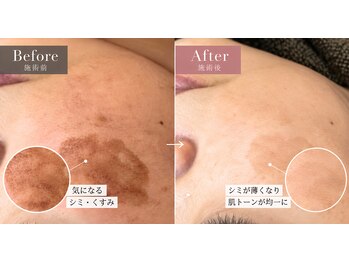 アクラフ 北千住(akurah)の写真/40.50代人気。シミくすみさよなら。大人の肌管理。