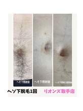 リオンズ 茨城ミスターマックス取手店/【脱毛】全身一気にツルスベに