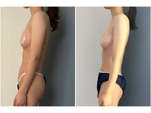 モア(moa)/バスト&ヒップアップ