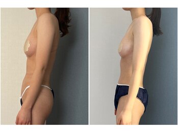 モア(moa)/バスト&ヒップアップ