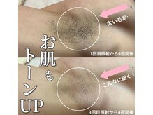 サロン(SALON)/メンズ脱毛：ワキ