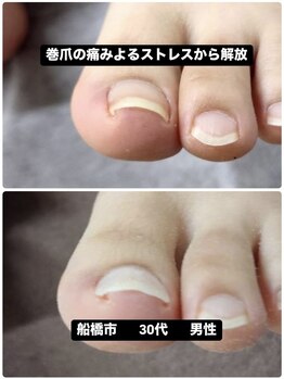 巻き爪じゅん 船橋店/巻爪による痛みのストレス解放!