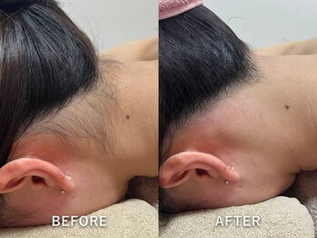 サロンドジェシカ(salon de Jessica)/うなじ脱毛/デザイン