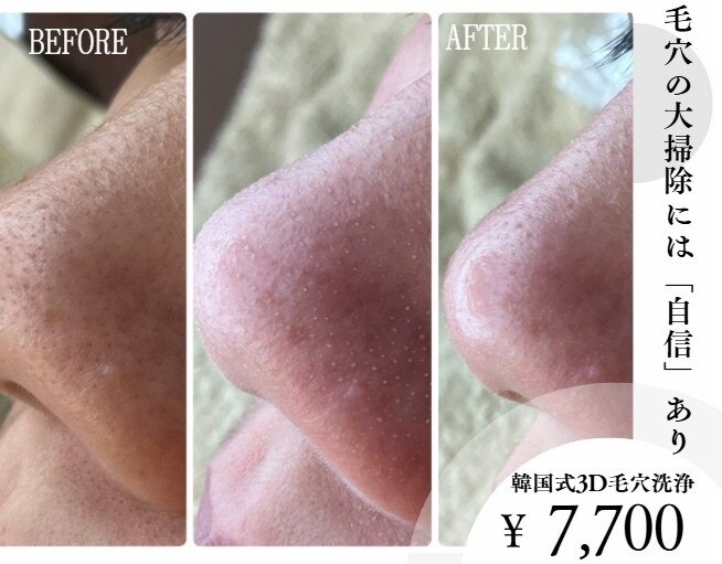 熊本市で毛穴洗浄・毛穴吸引が人気のエステサロン｜ホットペッパー