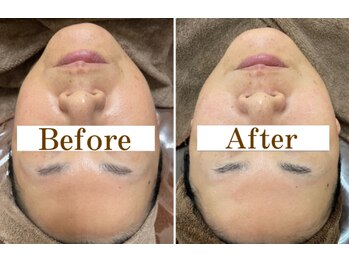 フォルチェ ゆめタウン広島店(Folche)/肩/小顔/しわ/たるみケアに★