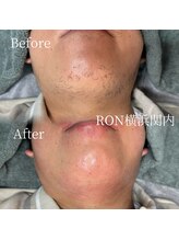 サロンロン 横浜関内(SALON RON)/髭の脱毛/美容電気脱毛