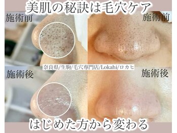 ロカヒ(Lokahi)/毛穴エクストラクションプロ