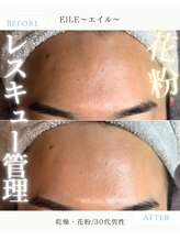 エイル(EILE) 花粉症 肌荒れ