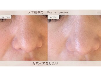 ユヌランコント 岐阜店(Une rencontre)の写真/毛穴は“取る”より“育てる”エンビロン＆ハーブピーリングの肌管理!メイクいらずの素肌を目指したい方に!