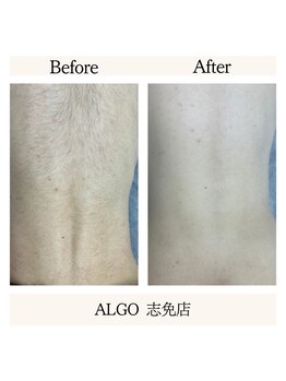 アルゴ 志免店(ALGO)/劇的変化!光フェイシャル