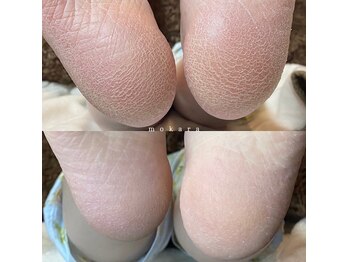 ◇フット角質ケア◇