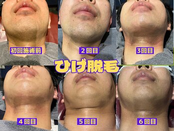 イデアル(ideal)/ひげ脱毛　