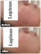 ルピナス(Lupinus)/透明感が出て毛穴もキュッ！