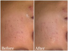 サロンドフェイス(Salon de Faith)/【ハーブピーリング】1回施術♪