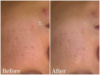 サロンドフェイス(Salon de Faith)/【ハーブピーリング】1回施術♪