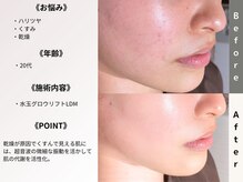 ルディラ 恵比寿店/水玉グロウリフト(韓国式LDM)