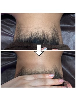 リエル(RIEL)/うなじ脱毛