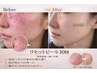 calin式リセットピール☆ニキビ用ピーリング☆赤ニキビ、肌トラブル、詰まり