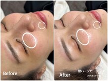 ラウレア(LAULEA)/ハーブピーリンBefore/After